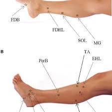 Sites Of Emg Electrode Placement For Muscles In The Foot And