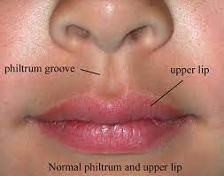 philtrum of lip causes of smooth