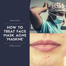 how to treat face mask acne maskne