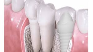recovery after dental implant surgery