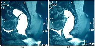 dynamic pelvic mri at rest a and