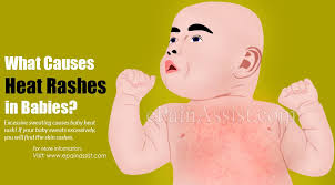 what causes baby heat rash what is
