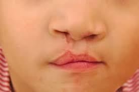 cleft lip and palate surgery herzliya