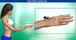 Snake venom can cause problems in the cardiovascular system, specific muscle groups, or the nervous system. Black Widow Spider Bite Signs Symptoms Treatment Hot Bath Ibuprofen Antivenin
