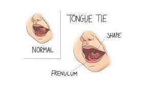 lip ties causes symptoms and