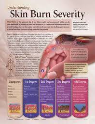Understanding Skin Burn Severity Chart 20x26 The Life Of A