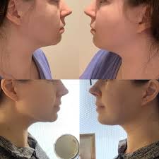 Maybe you would like to learn more about one of these? 8 Months Post Chin Lipo I Actually Have A Jawline Now Plasticsurgery