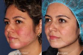 treating rosacea with ipl cosmetic