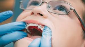 Pediatric Dentistry : Orthodontics : Orthodontics Patient Education : Diseases and Conditions | Pediatric Oncall