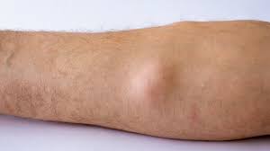 lipoma what it is causes symptoms