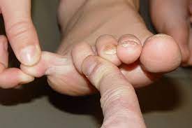 nail fungus symptoms and treatment