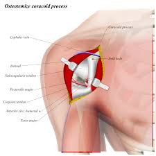 Shoulder tendonitis, also known as rotator cuff tendonitis, is an inflammation of the rotator cuff muscles in the shoulder. Shoulder Anterior Deltopectoral Approach Approaches Orthobullets