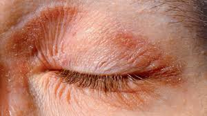 eczema on the eyes causes symptoms