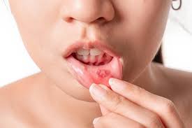 what is mouth ulcer types causes