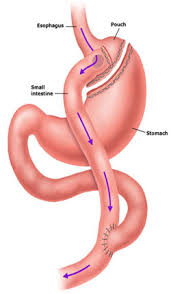 roux en y gastric byp coastal