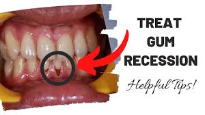 minimize gum recession at home you