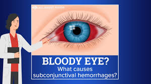 subconjunctival hemorrhage blood in
