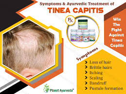 tinea capitis with herbal remes