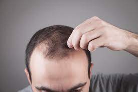 hypothyroidism and hair loss