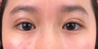 instant double eyelid cosmetic surgery