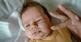 eczema on child s face causes