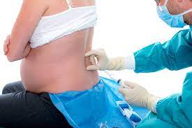 back pain after epidural causes and