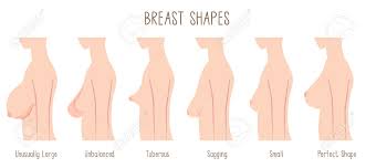 Breast Shape Chart Comparing Large Unbalanced Tuberous Sagging Small