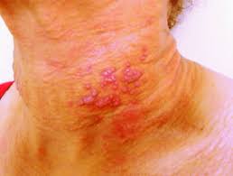 herpes simplex vesicles 15 days after