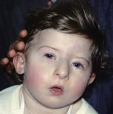 Learn what this is and why it puts your child at higher risk of heart problems. Digeorge Syndrome Wikipedia