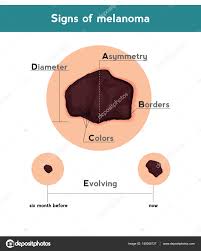 Melanoma Abcde Signs Vector Illustration Of Skin Patch With