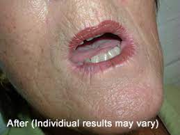 lip veins sutherland skin cancer