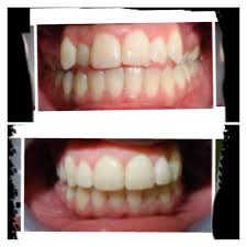 Each dentist at the practice has their own special interest. Before And After Braces I Love My Results It Took A Total Of 14 Months After Braces Braces Transformation Dental Braces
