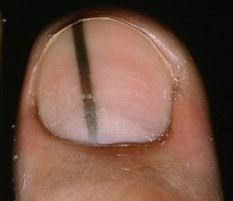 toenail melanoma