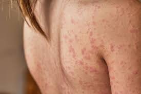hives treatment for children and toddlers