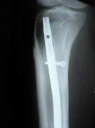 tibial fractures technique of im