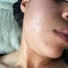 Best probiotic supplements for acne. Spironolactone For Acne Reviews Was It Worth It Realself