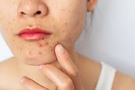 hormonal acne what you should know