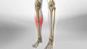 How to exercise with a broken foot. Tibia Fracture Treatment And Recovery Orthovirginia