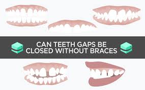 The official name for a gap in the teeth is diastema, and there are dental braces have been used for many years to straighten teeth, but they have also been a typical solution to getting rid of gaps in your teeth too. Braces For Teeth Gaps Teethwalls