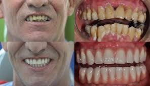 the cost of dental implants in colombia