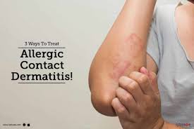 treat allergic contact dermais