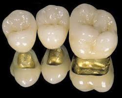 Pfm Dental Crown Anterior Teeth Posterior Teeth