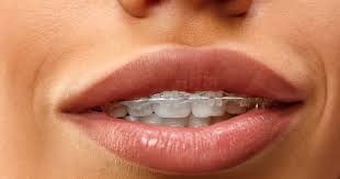 How to fix underbite with braces. Overbite Underbite Treatment Las Vegas Nevada Dentistry Braces
