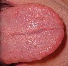 swollen tongue a minor or sometimes