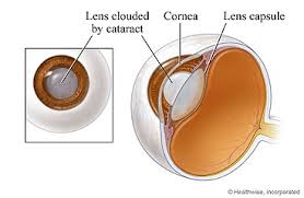cataract surgery what to expect at