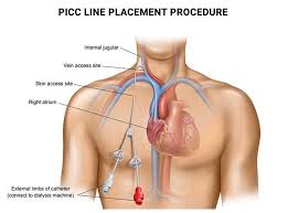 port or picc line placement vein