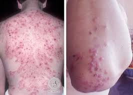 rash of dermais herpetiformis