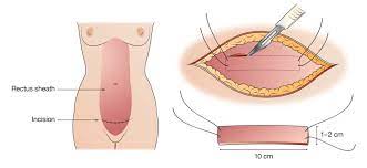 surgery for female urinary incontinence