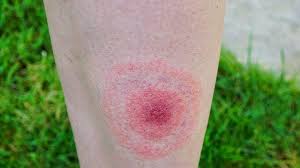 Brown recluse and black widow spider bites are medically significant in north america. What Bit Me How To Identify Common Bug Bites Everyday Health