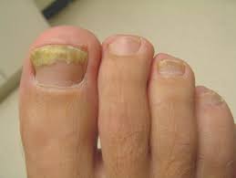 treat nail fungus on diabetic patients